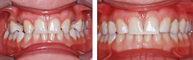 Implantologie Zähne