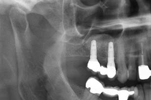 Knochenaufbau (Detail)