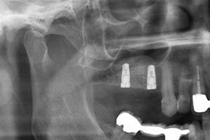Knochenaufbau (Röntgen)