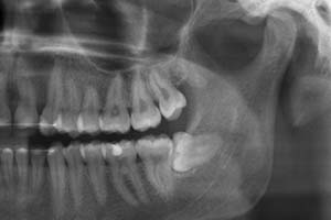 Weisheitszahnentfernung (Röntgenbild)