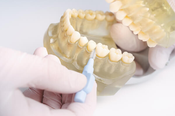 Zahnreinigung mit Interdentalbürste